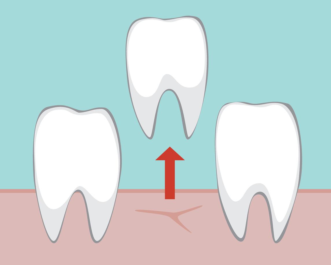 A tooth being removed from the mouth